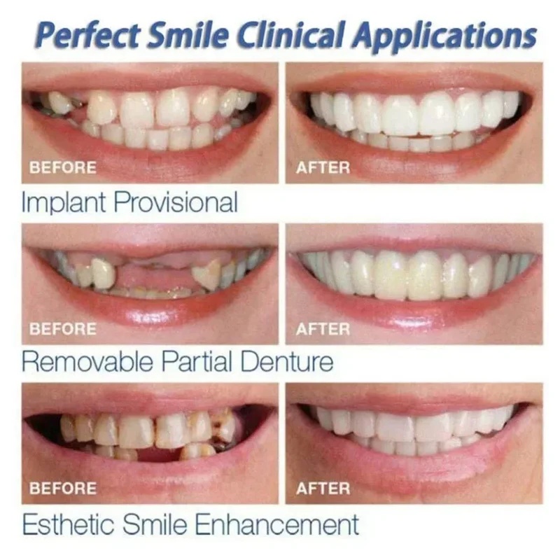 Snap-on Veneer Teeth Kit Adjus - Teeth Whitening Kit recension och pris